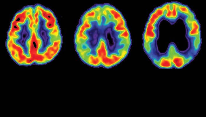 Diagnosi precoce della malattia di Alzheimer: EEG e PET a confronto - la Neurologia Italiana